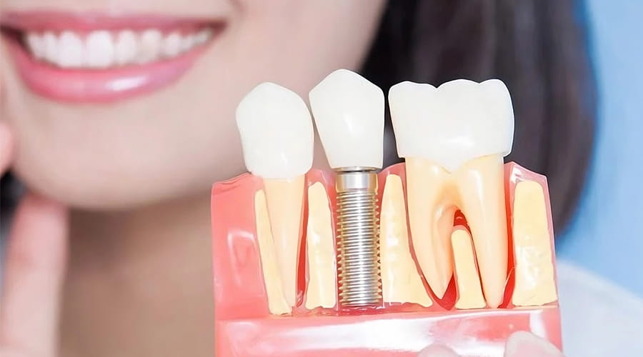implantes carga inmediata 2