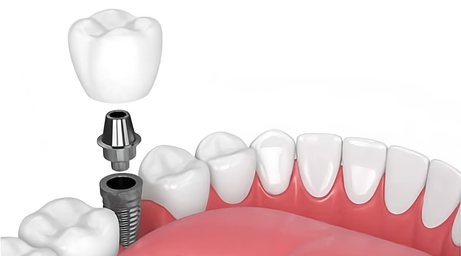 implantes carga inmediata 3