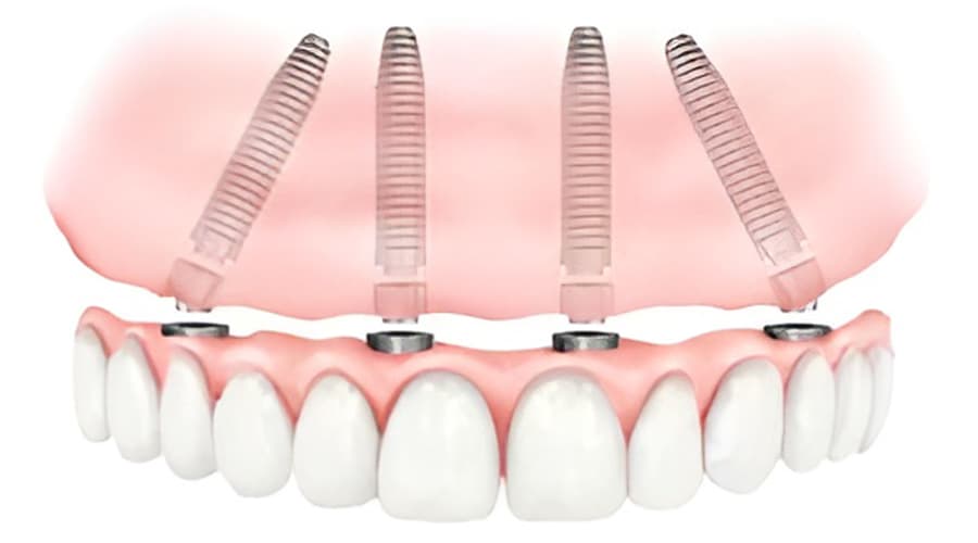 Implantes all on four 1
