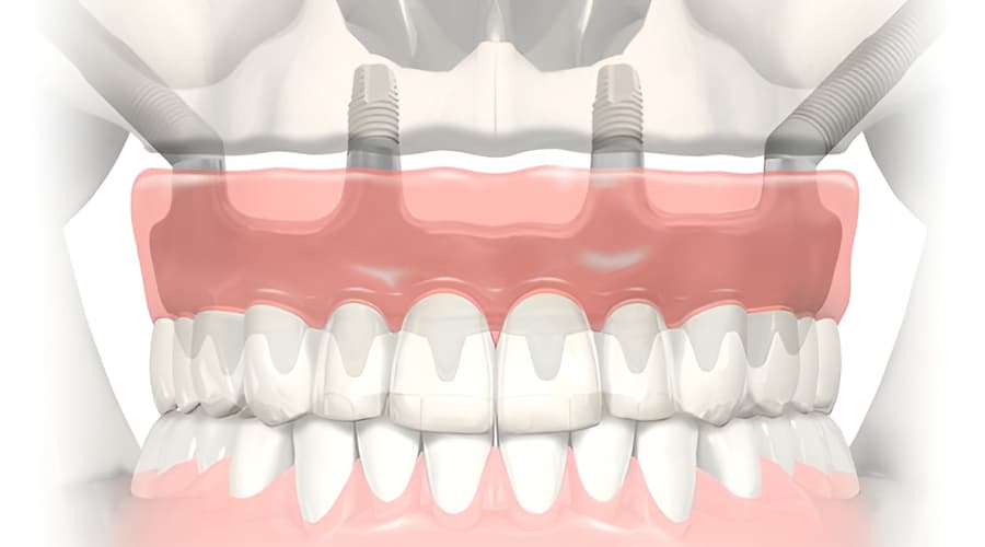 Implantes cigomaticos 1