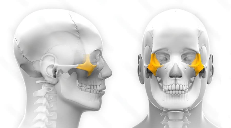 Implantes cigomaticos 2