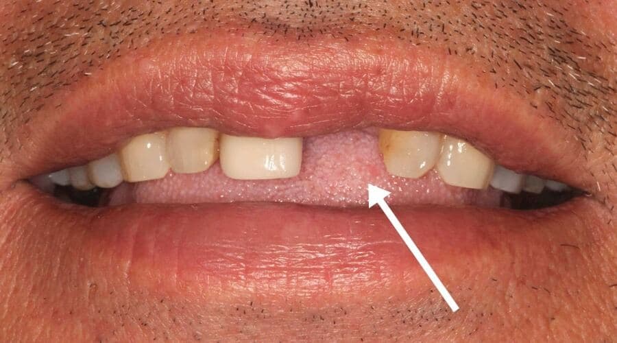 Pérdida dental en la «zona de la sonrisa» – Una de las razones para optar por implantes inmediatos tras una extracción. Pérdida dental en la «zona de la sonrisa» – Una de las razones para optar por implantes inmediatos tras una extracción.