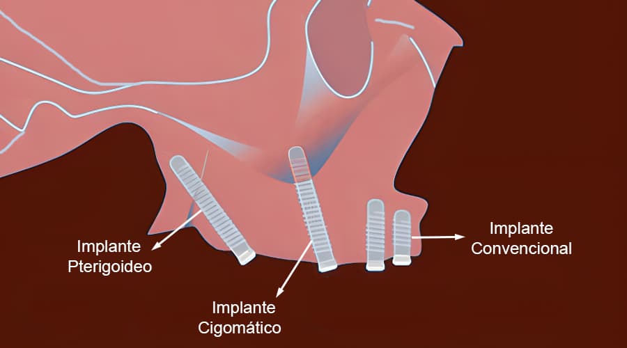 implantes pterigoideos 1