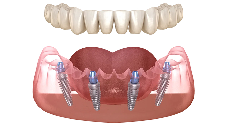 Implantes-all-on-four 1