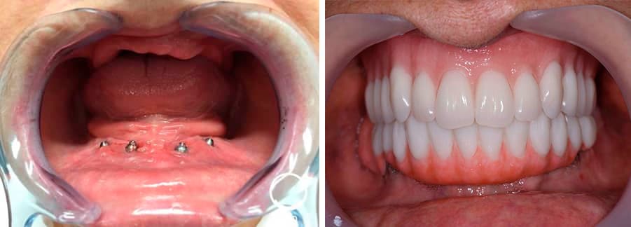 Implantes-all-on-four antes y depues